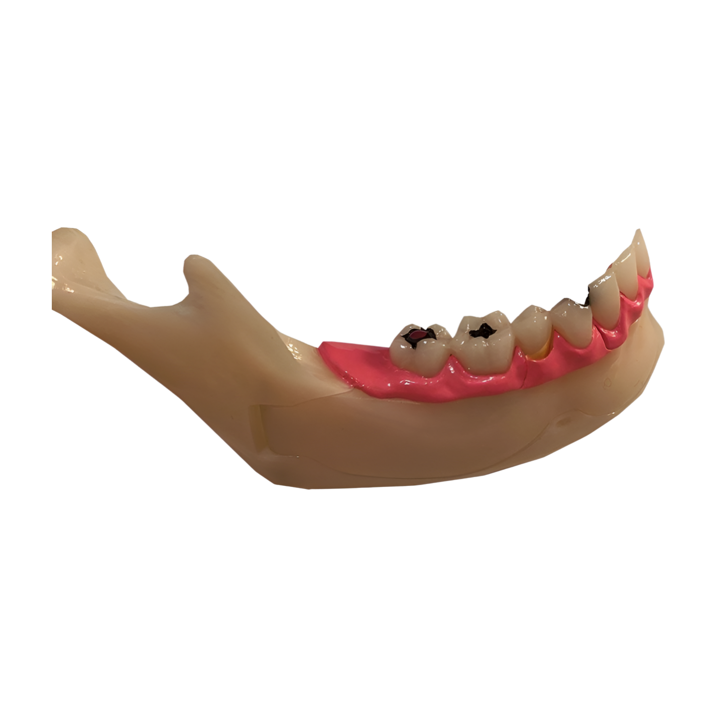 P13-TR.10 pathological mandible, impaction and abscess detail