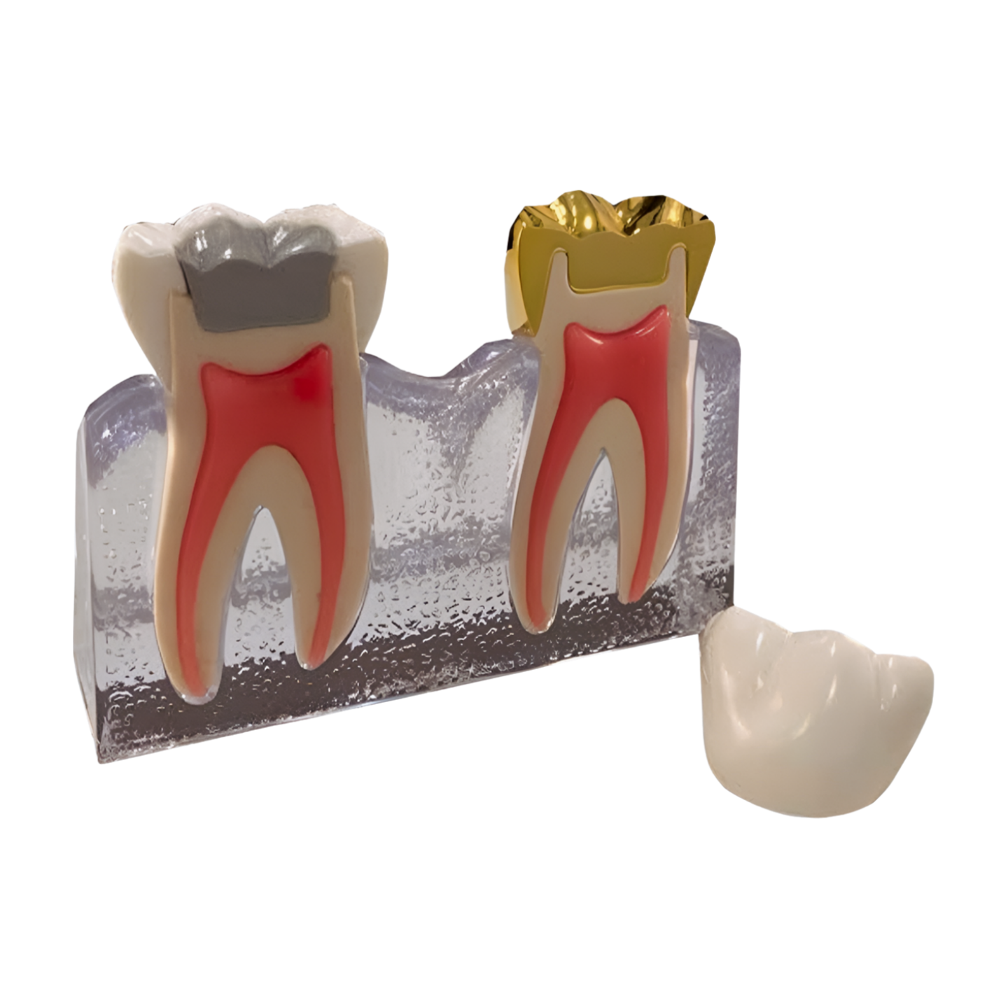 P13-TRM.447 cracked tooth model, pre-treatment cracked cusp