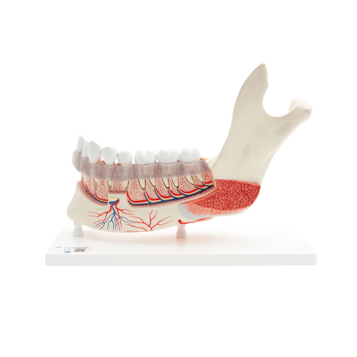Comprehensive Lower Jaw Model (Left Half) with Diseased Teeth, Nerves, Vessels & Glands, 19 part