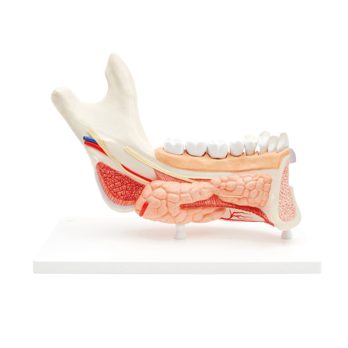 Comprehensive Lower Jaw Model (Left Half) with Diseased Teeth, Nerves, Vessels & Glands, 19 part