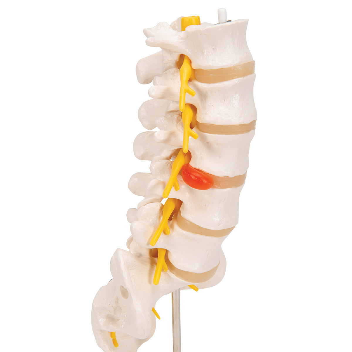 The lumbar model includes a dorso-lateral prolapsed inter-vertebral disc | 3B Scientific A76/5