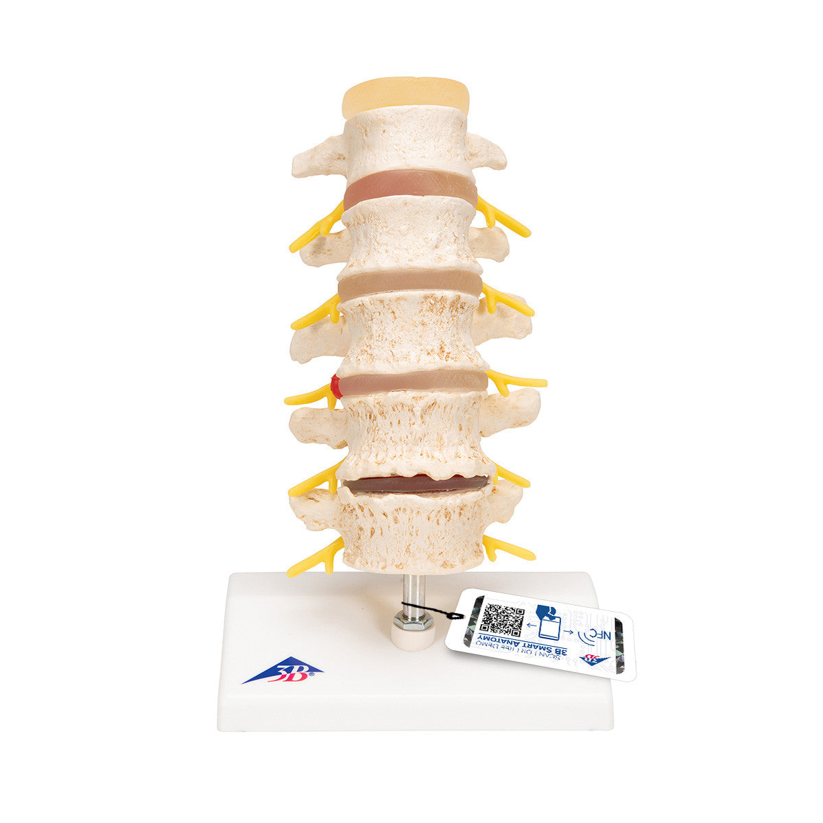 a795_01_1200_1200_stages-of-disc-prolapse-and-vertebral-degeneration-3b-smart-anatomy__26596.1589753282.1280.1280.jpg