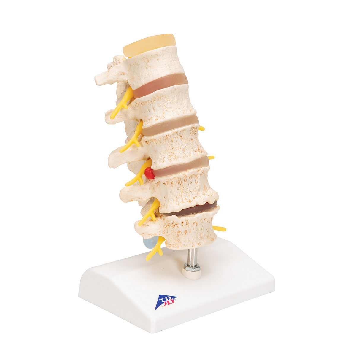 a795_02_1200_1200_stages-of-disc-prolapse-and-vertebral-degeneration-3b-smart-anatomy__80698.1589753277.1280.1280.jpg