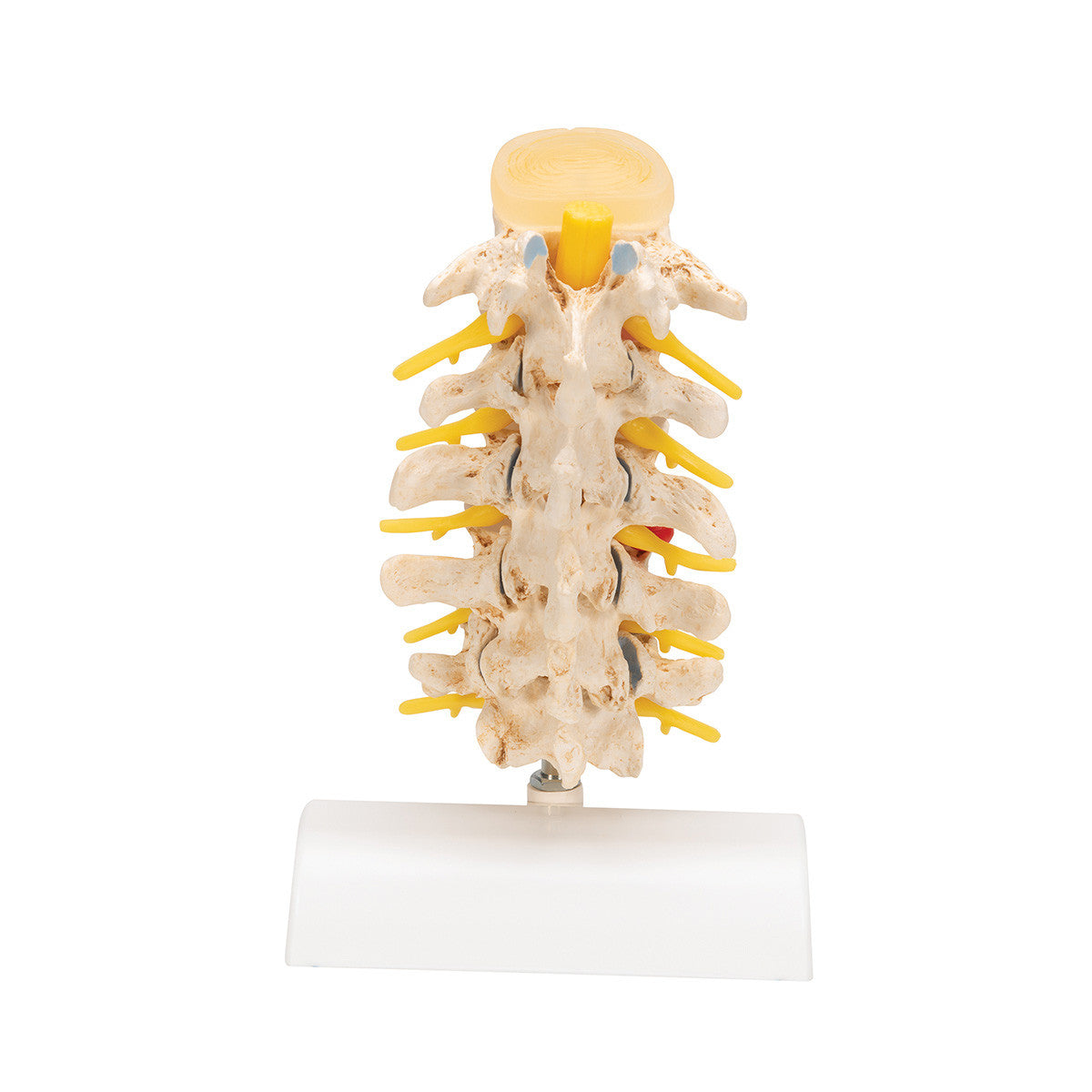 a795_04_1200_1200_stages-of-disc-prolapse-and-vertebral-degeneration-3b-smart-anatomy__51418.1589753278.1280.1280.jpg