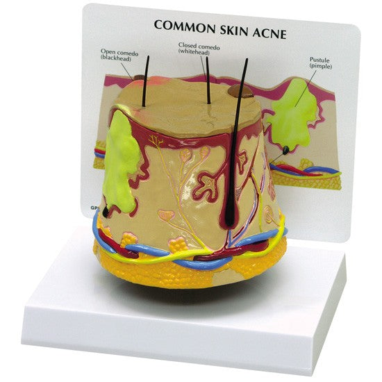 Common Skin Acne