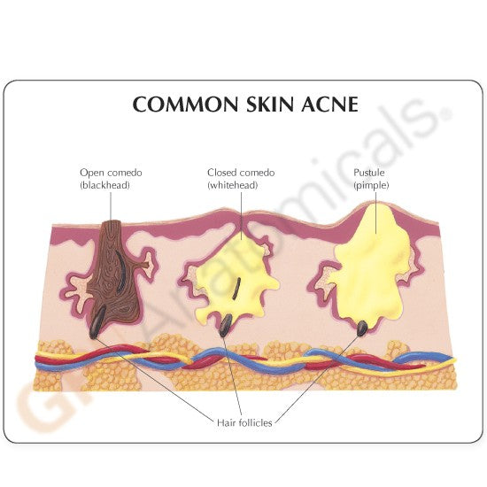 Common Skin Acne