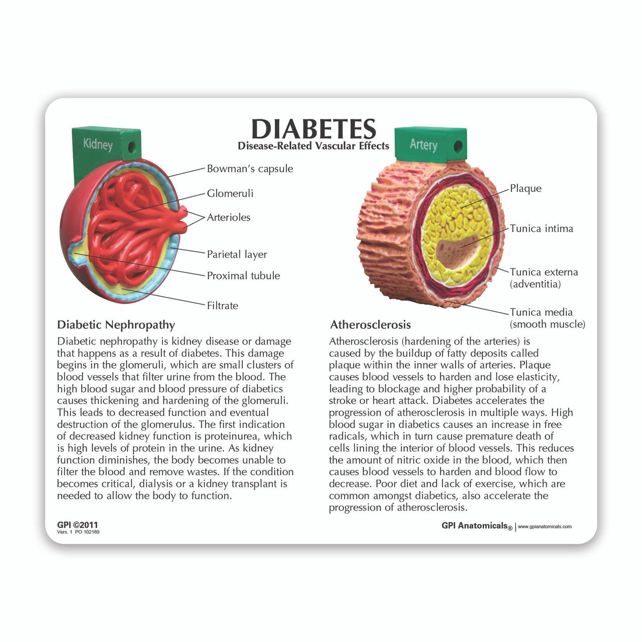 4-Piece Diabetes model - card back