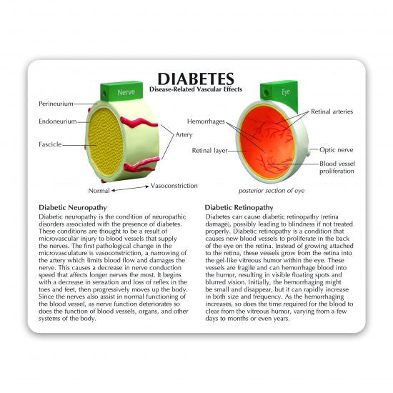 4-Piece Diabetes model - card