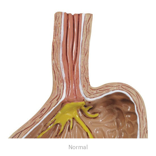 4-Piece GERD (Gastroesphageal Reflux Disease)