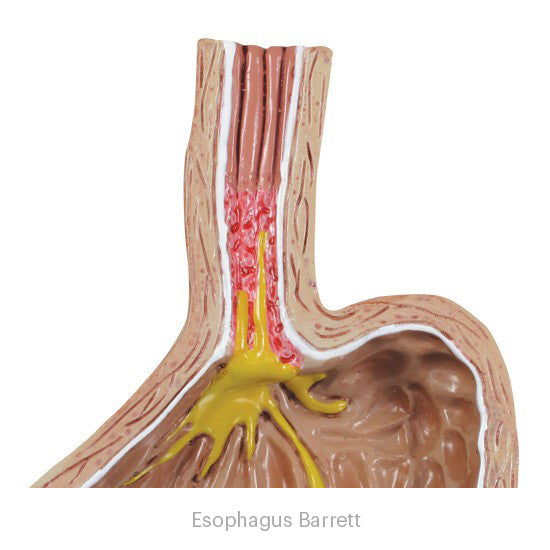 4-Piece GERD (Gastroesphageal Reflux Disease)