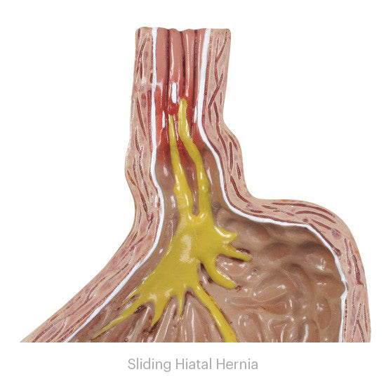 4-Piece GERD (Gastroesphageal Reflux Disease)