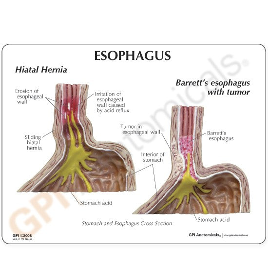 4-Piece GERD (Gastroesphageal Reflux Disease)