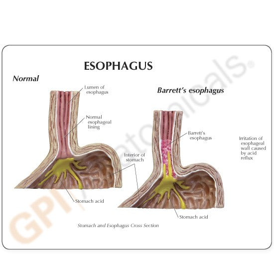 4-Piece GERD (Gastroesphageal Reflux Disease)