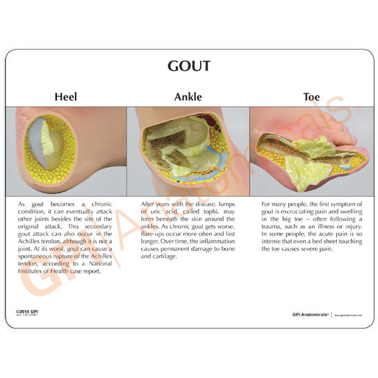 Gout (Foot)