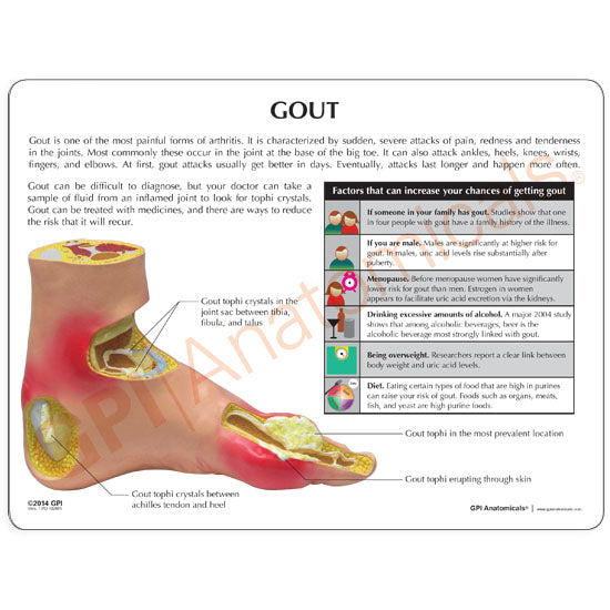 Gout (Foot)