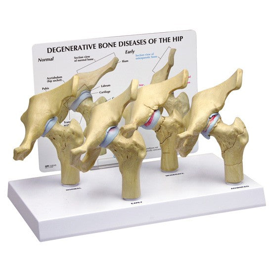 4-Stage Degenerative Hip Set