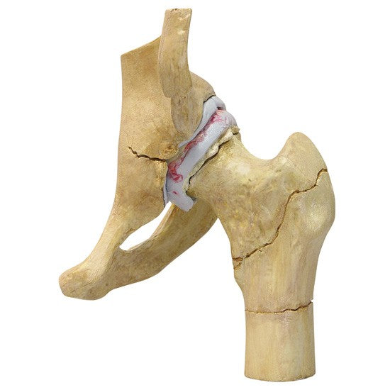 4-Stage Degenerative Hip Set