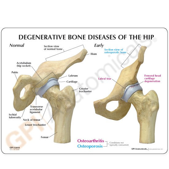 4-Stage Degenerative Hip Set