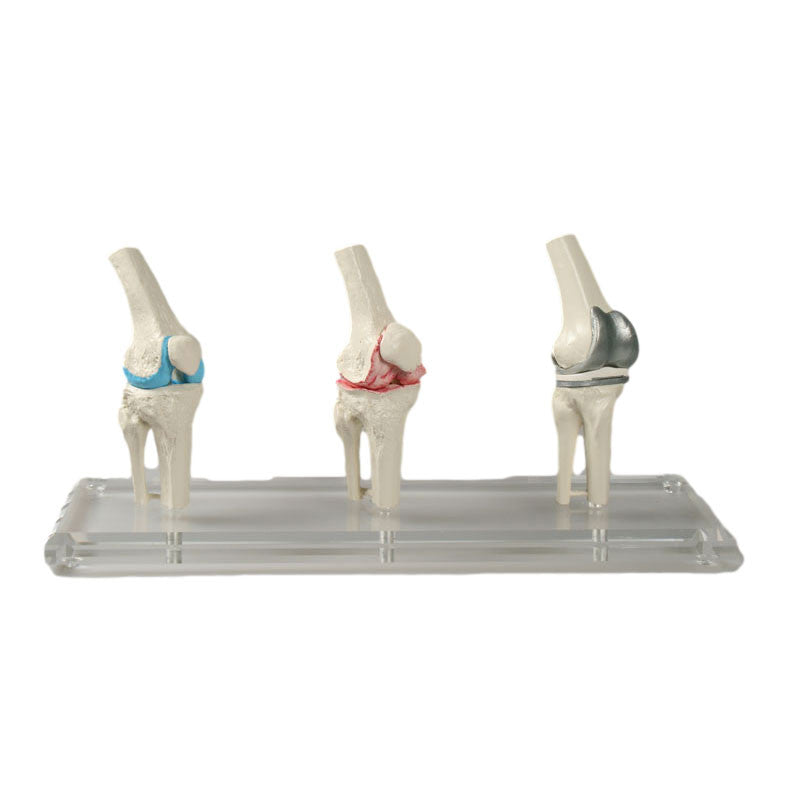 Knee Replacement Model Set