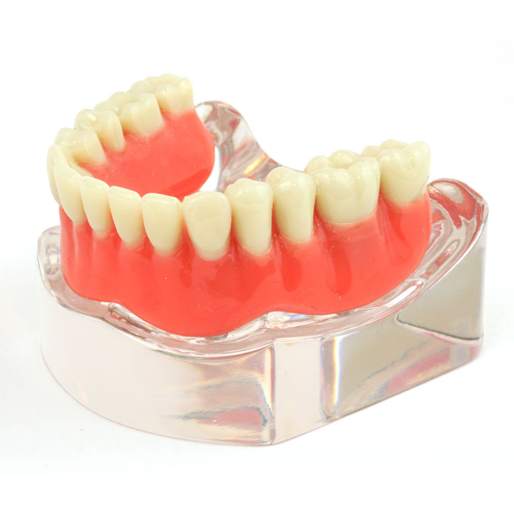 lower-denture-model-4-locator__34970.1589752874.1280.1280.jpg