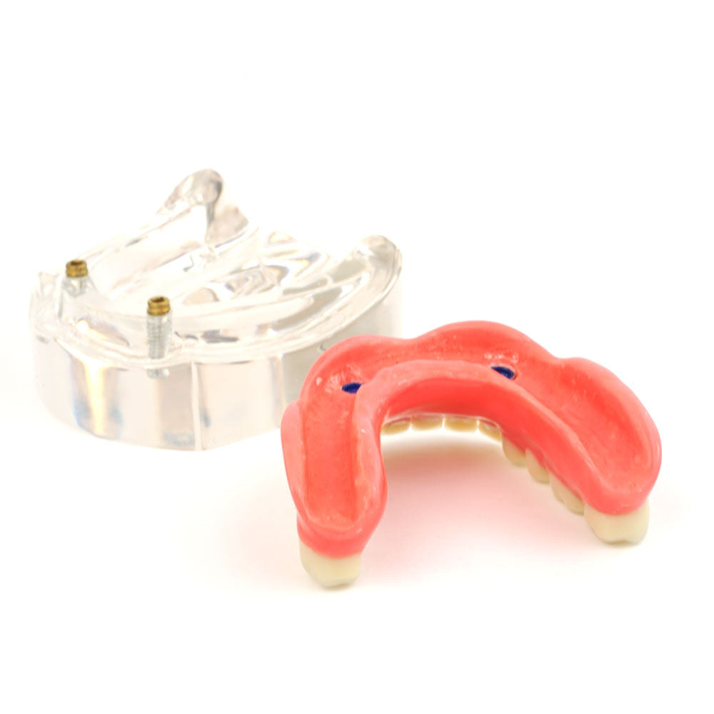 Overdenture model using 2 implant locators on a lower arch