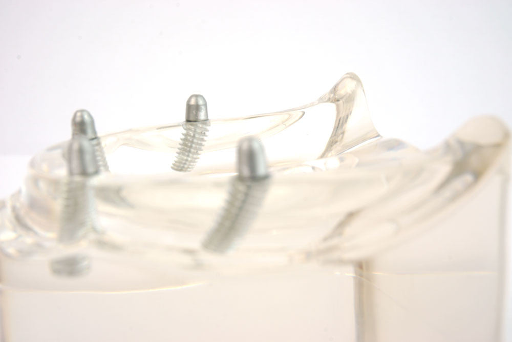 Lower denture model on 4 "pin style" abutments