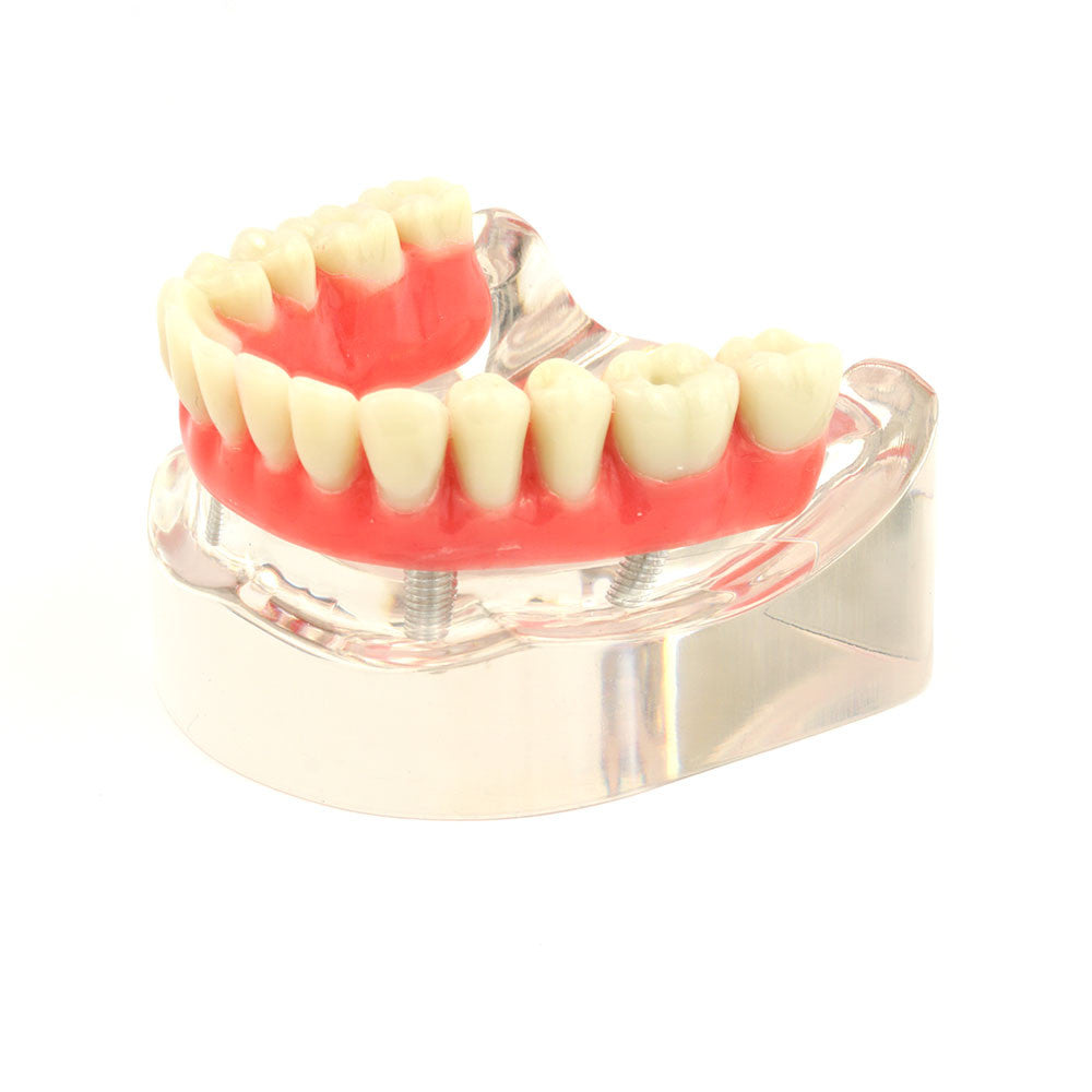 Lower denture model on 4 "pin style" abutments