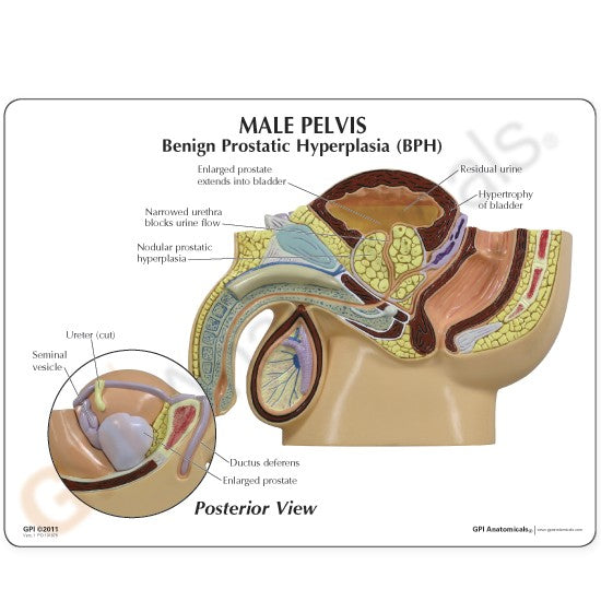Male Pelvis with BPH Insert