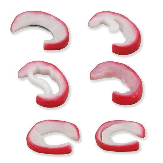 Meniscus Tears (6 Tears)