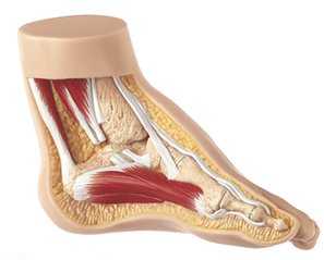 Club foot