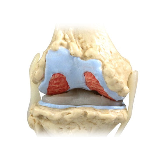 4-Stage Osteoarthritis Knee Set