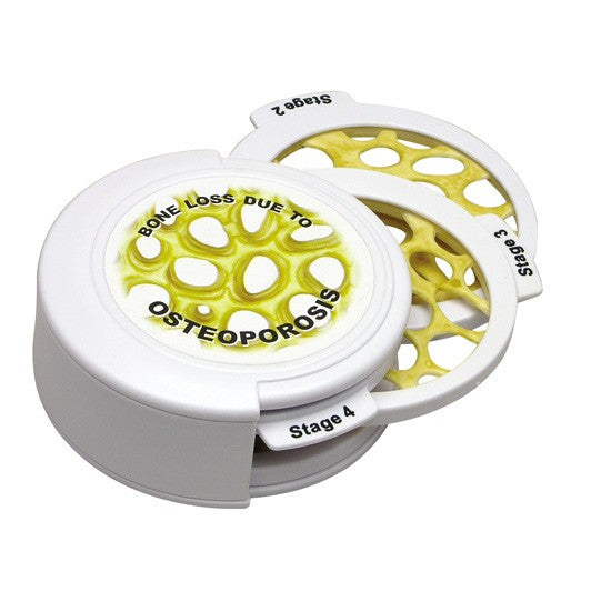 Osteoporosis Hinged Disk Set