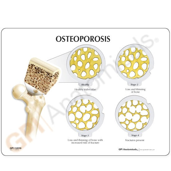Osteoporosis Hinged Disk Set