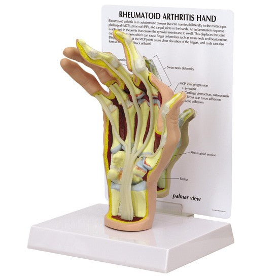 Rheumatoidarthritis (RA) Hand
