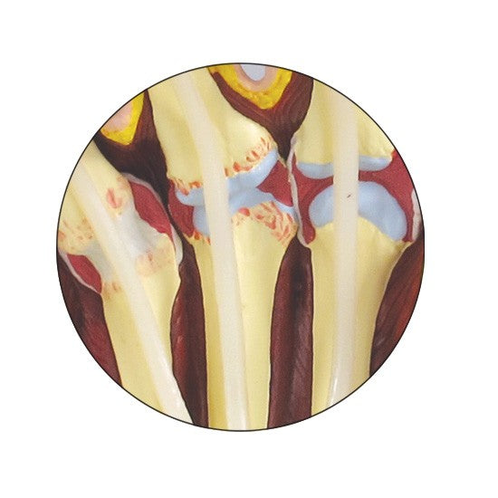 Rheumatoidarthritis (RA) Hand