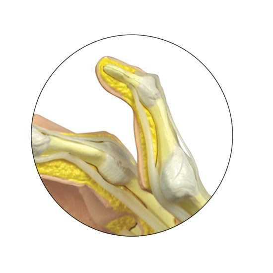 Rheumatoidarthritis (RA) Hand
