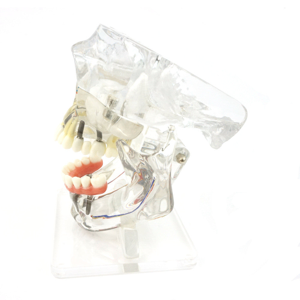 Transparent Implant Model with Sinus - side view