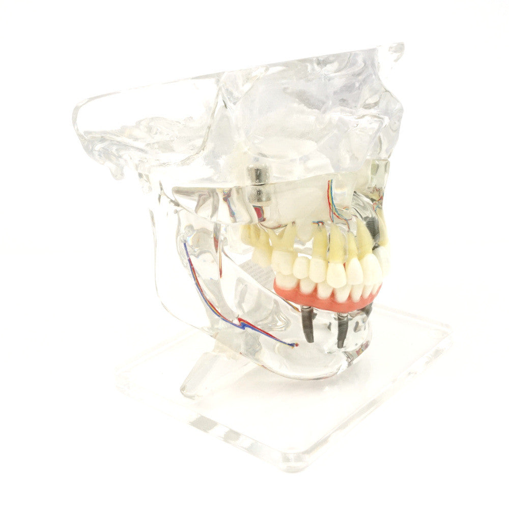Transparent Implant Model with Sinus - on stand