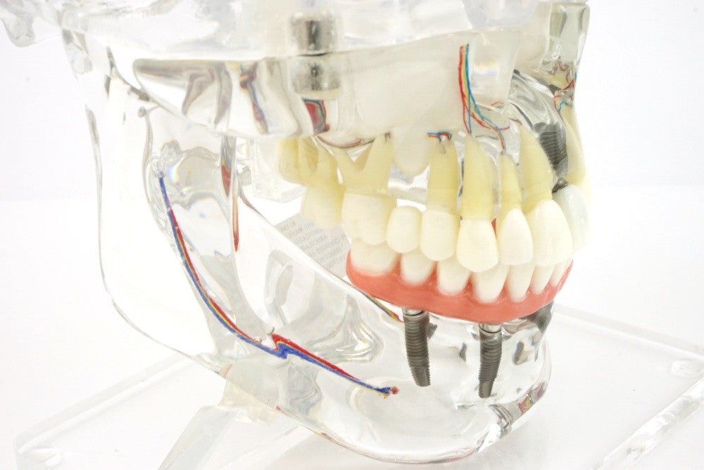 Transparent Implant Model with Sinus - detail