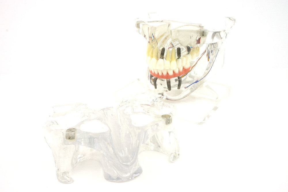 Transparent Implant Model with Sinus - disassembled, anterior