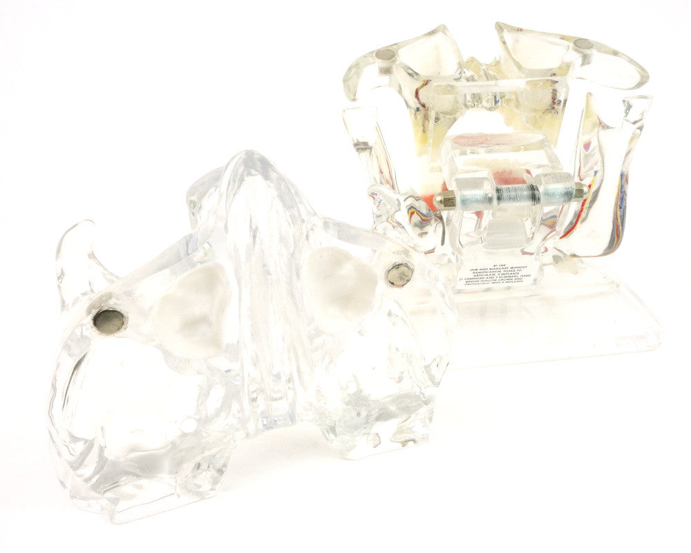 Transparent Implant Model with Sinus - disassembled, posterior