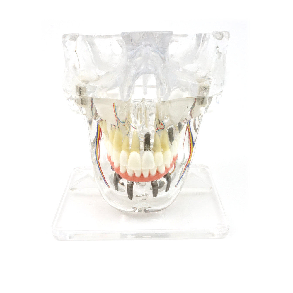 Transparent Implant Model with Sinus - front view