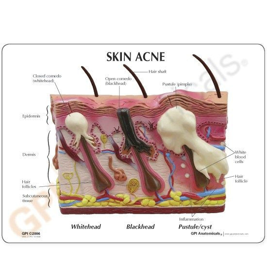 skin-acne-model-3-550x550__39132.1643511677.1280.1280.jpg