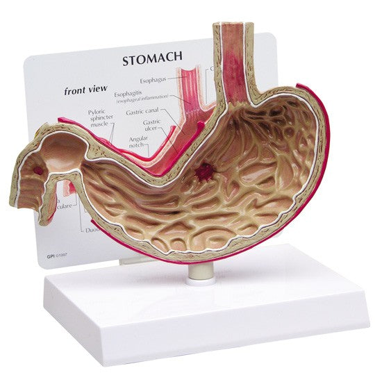 Stomach (with Ulcers)