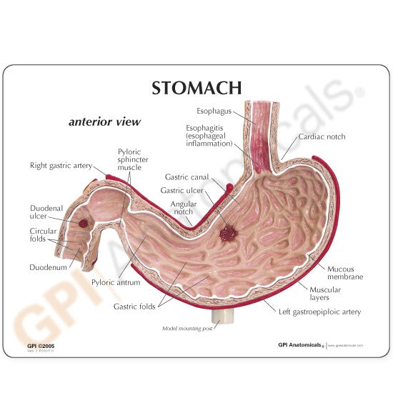Stomach (with Ulcers)