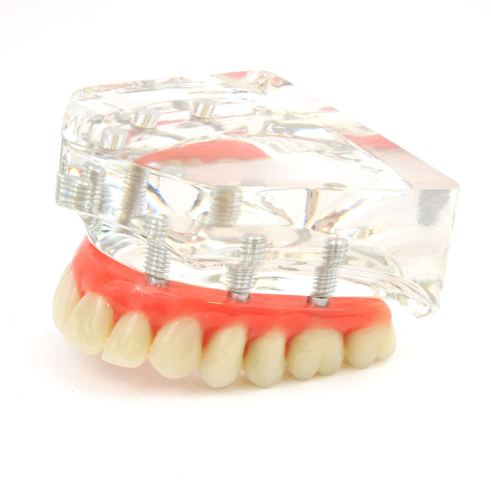 Upper denture model on 6 pin style abutments