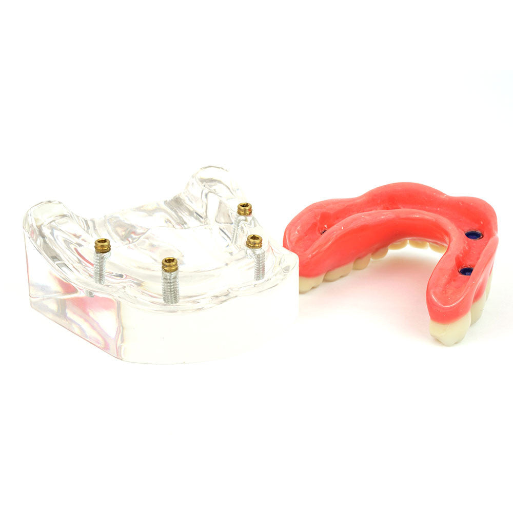 Upper denture model on 4 locator attachments