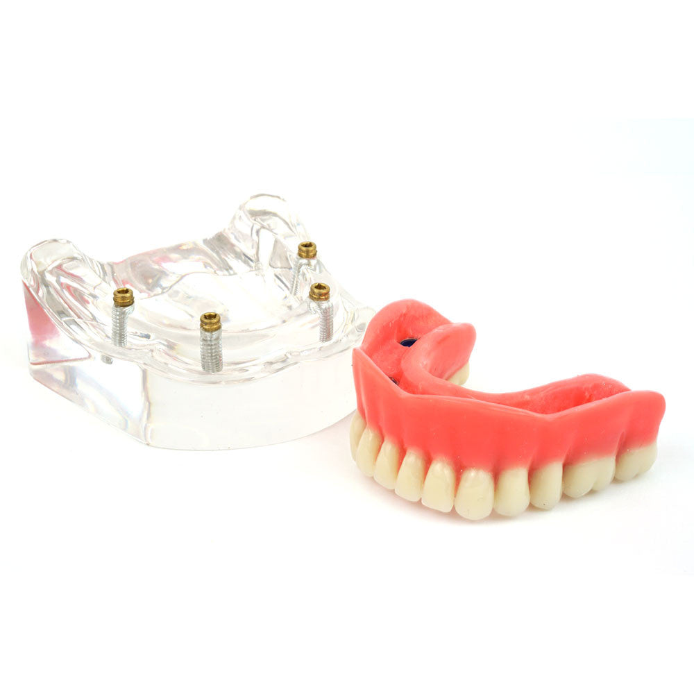 Upper denture model on 4 locator attachments
