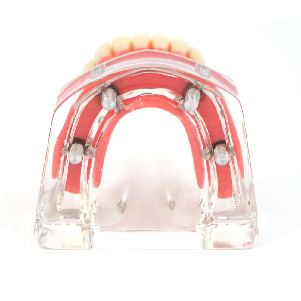 Upper denture model on 4 locator attachments