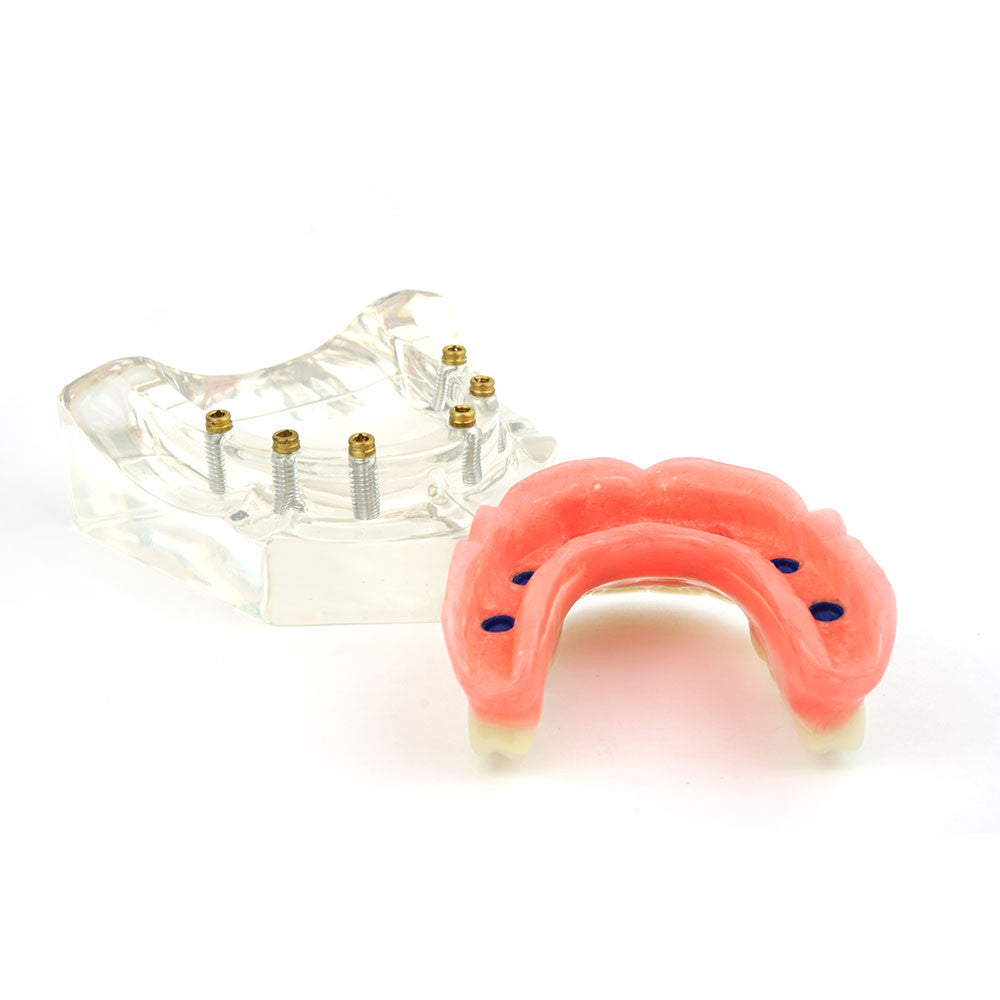 Upper denture model on 6 locator attachments